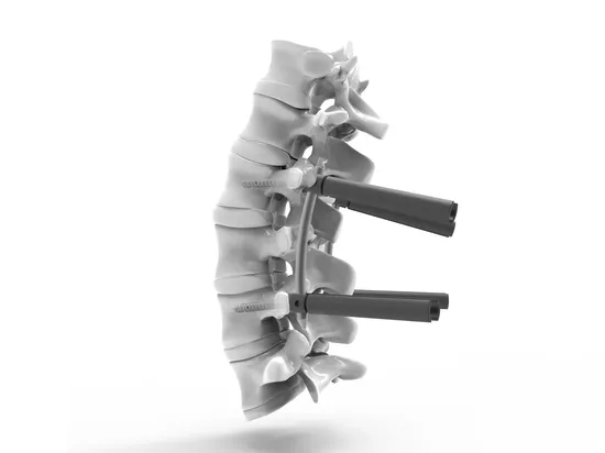 Minimally Invasive Surgery Mis Spine Implant