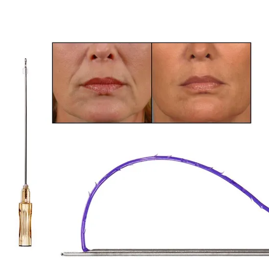 Face Lifting L Cog 21g 60mm Pdo Thread for Deep Wrinkle