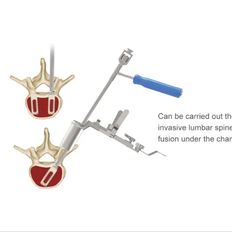 Spine Minimally Invasive Channel Retractor Instruments for Mis System