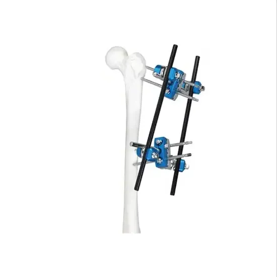 Customized External Fixation Device for Femoral Fracture Stent External Fixator System Orthopedic Surgery Instrument