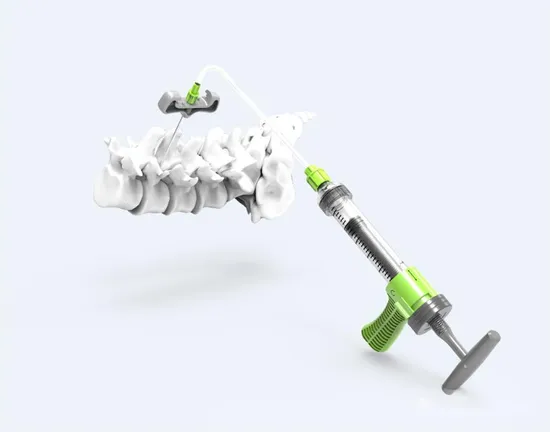 Orthocare Orthopedic Surgery CE Sterile Pkp Transparent & Light Green Bone Cement Injector