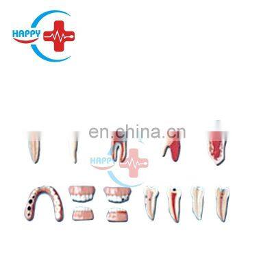 HC-S412 Medical Dental lesion series model science dental diease model teeth lesions teaching model